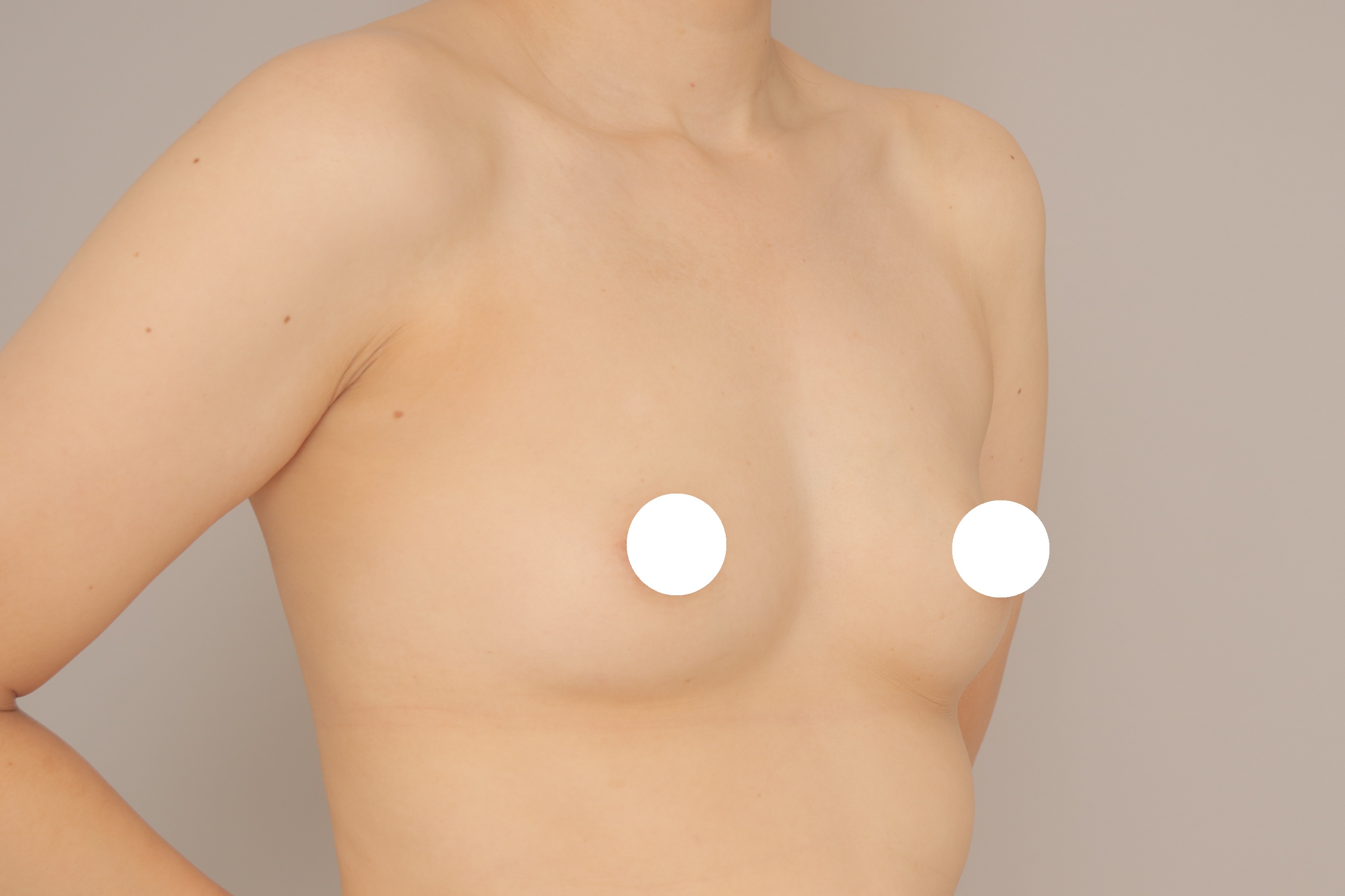 ベイザー脂肪吸引（６か月経過：34）の術前写真
