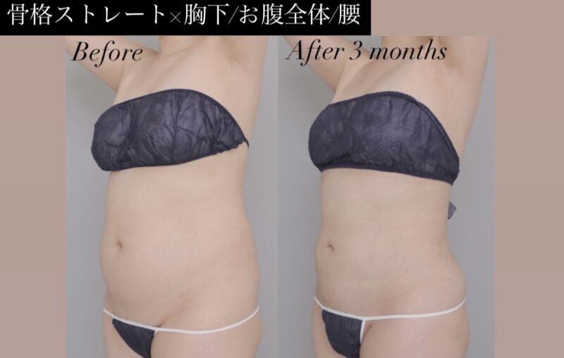 ●骨格ストレート×胸下＋腹＋腰 （術後6ケ月）20代女性 160cm 60kg のモニター様