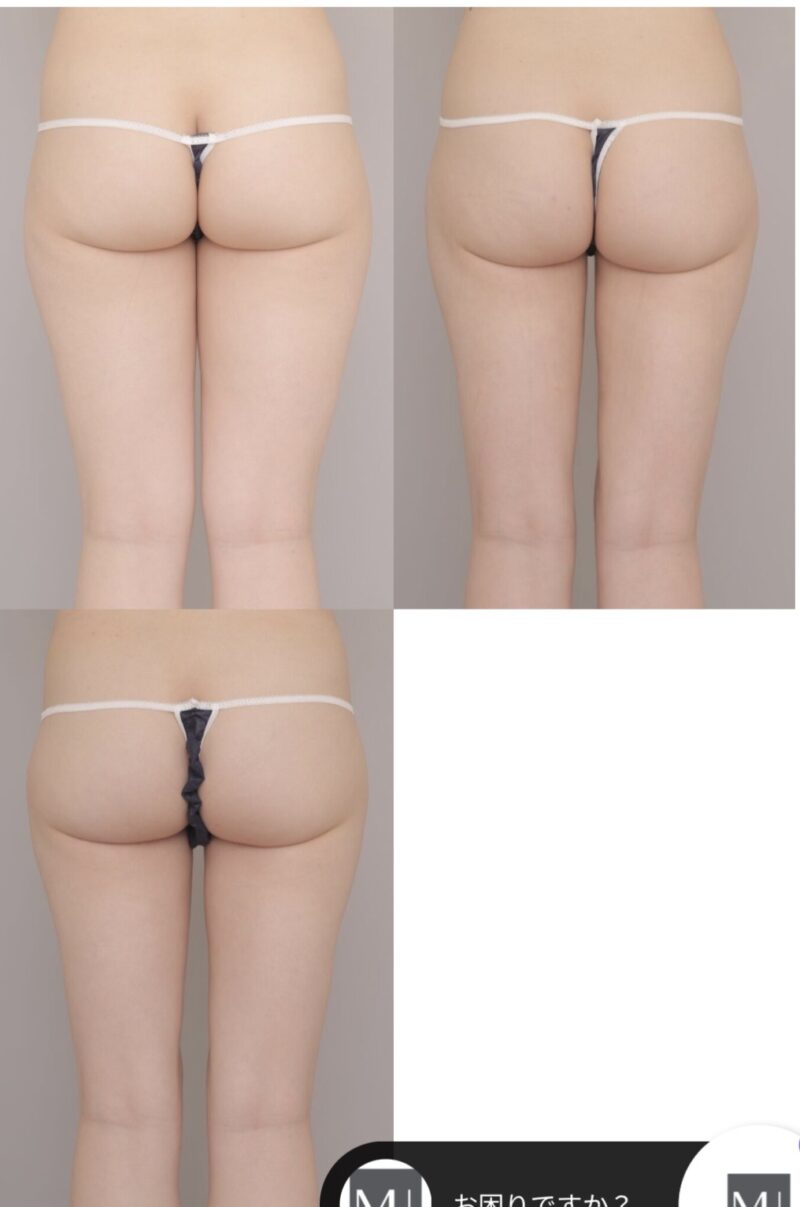 太もも上部の〝すき間〟の術後３か月、半年　～23歳156cm50kg太もも全周膝臀部2400cc吸引後時系列三ヶ月半年～